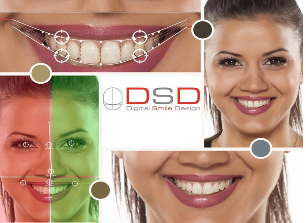 What is digital smile design