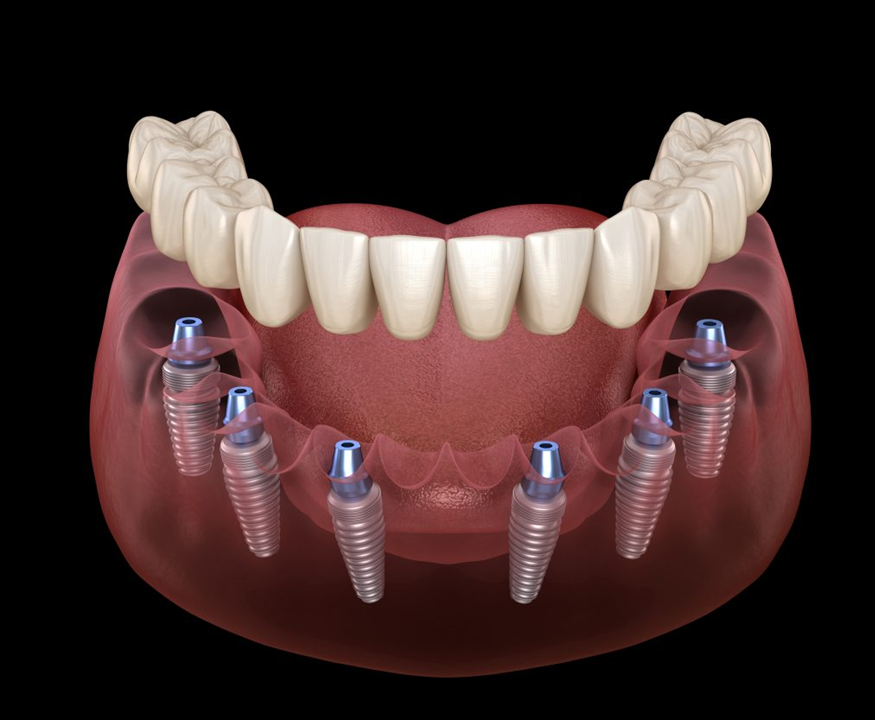 What are all on 6 dental implants