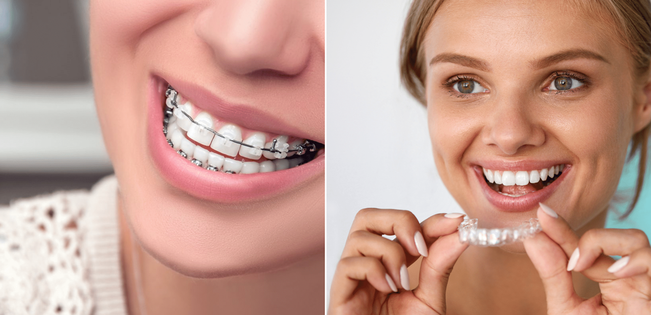 Invisalign vs braces