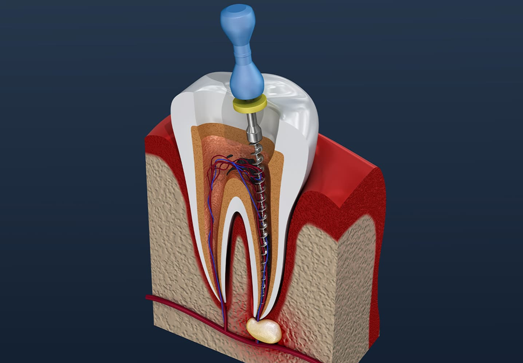 Understanding step by step root canal procedure