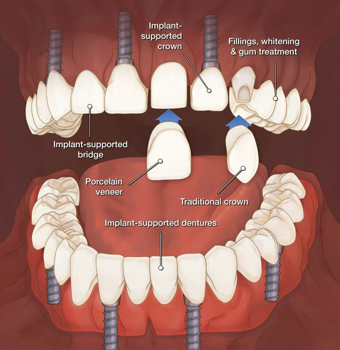 What is full mouth rehabilitation and step by step procedure
