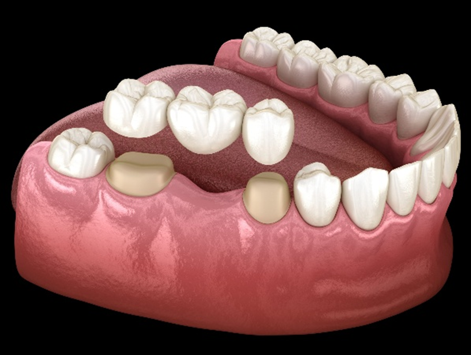Step by step procedure for crown and bridge