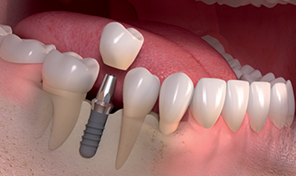 Dental implants immediate loading- teeth in a week