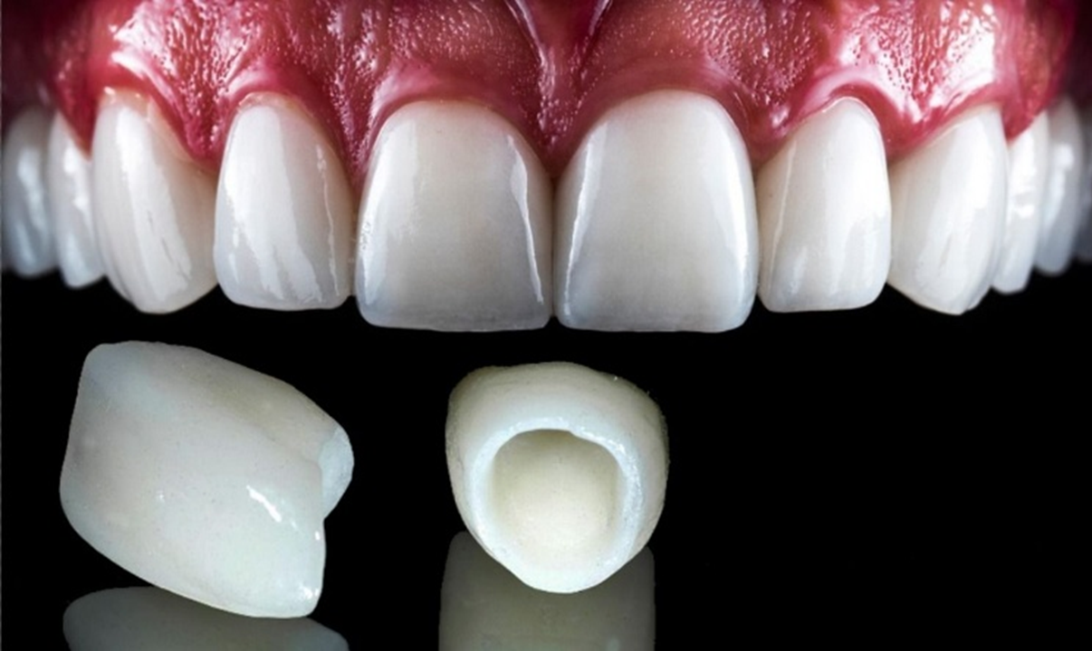 Types of dental crowns- everything you should know