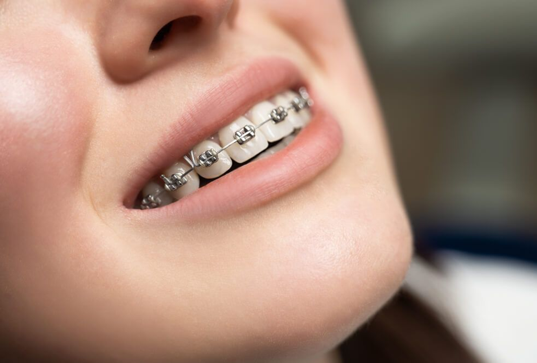 Step by step procedure for dental braces