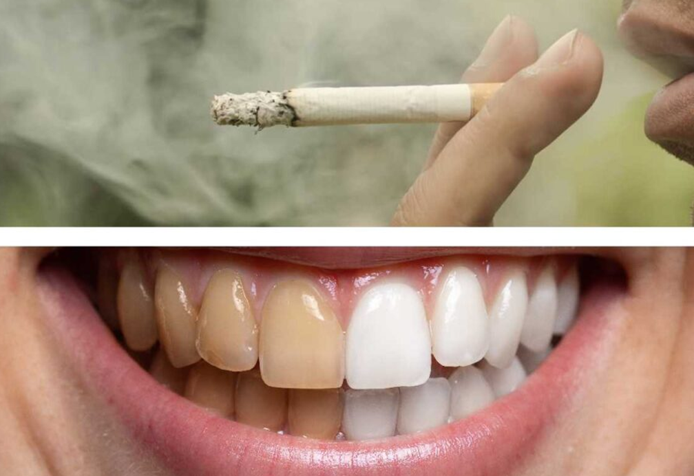 Effects of smoking and cigarettes on teeth, gums, oral tissues, and overall health