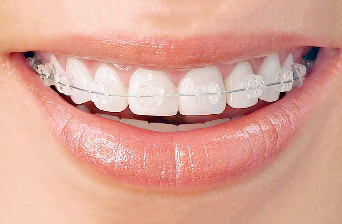What are dental braces and types of dental braces