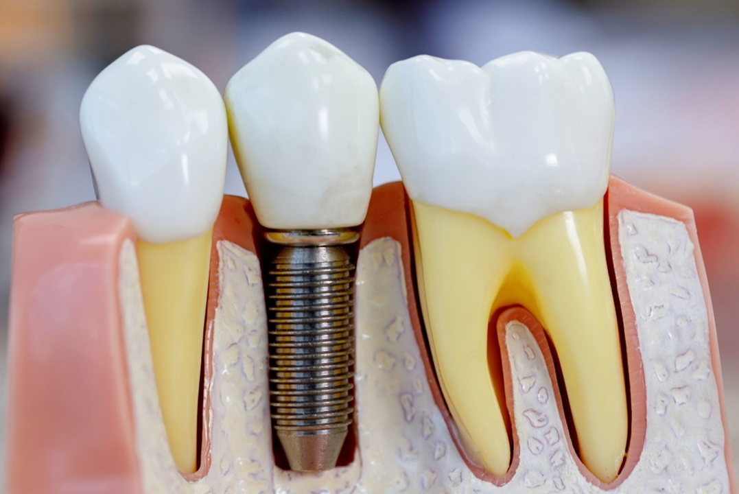 Cost of dental implants in India