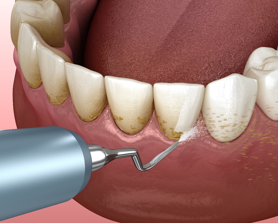 How to perform dental cleaning procedure