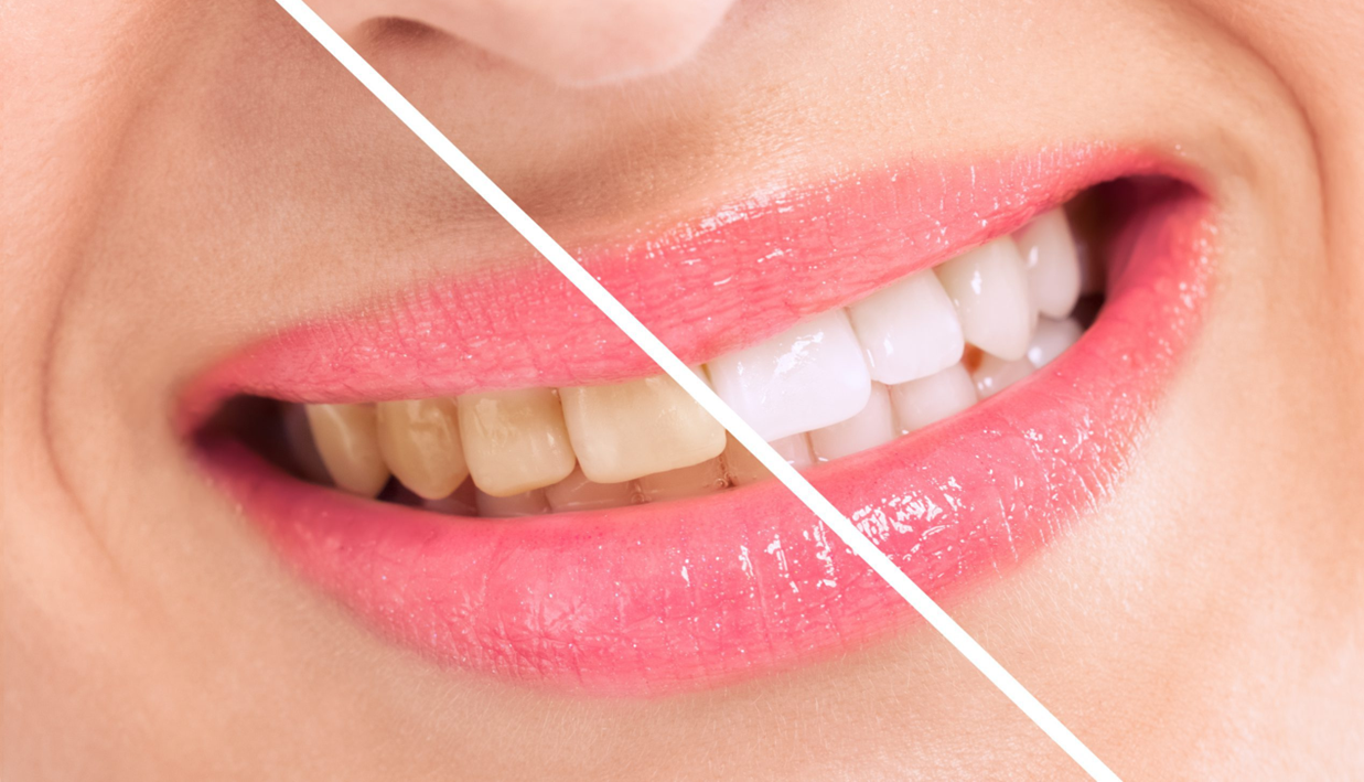 Step by step procedure of teeth whitening
