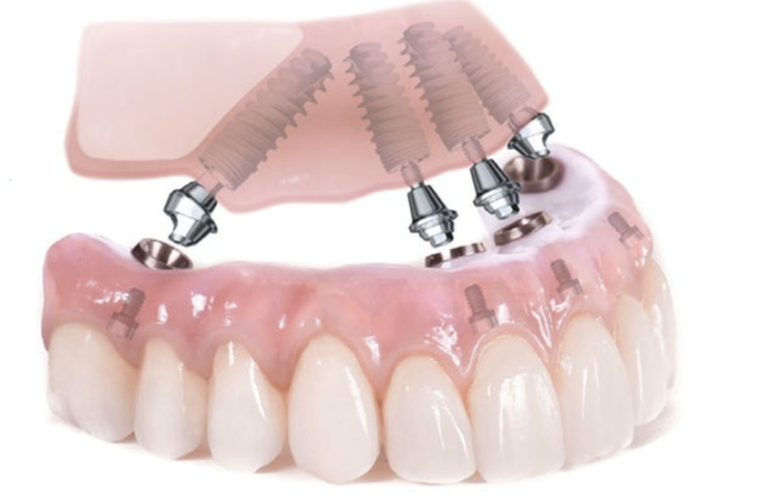 What are all on 4 dental implants