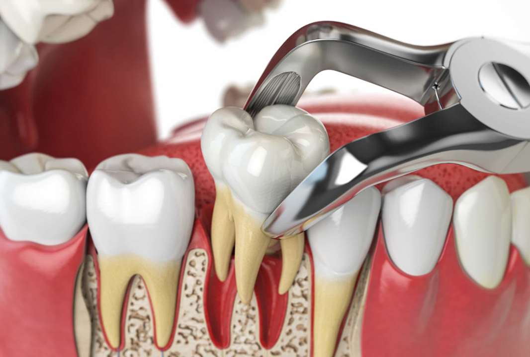 What is extraction and step by step procedure