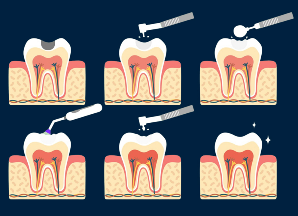 Step by step procedure of dental composite filling