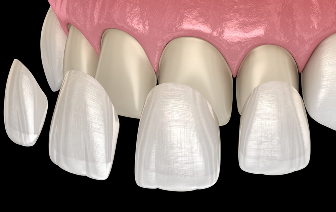 Step by step procedure of dental porcelain veneers