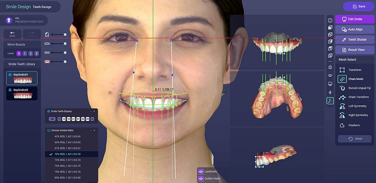 Use of digital smile design for smile makeover with dental veneers