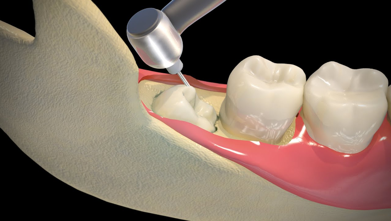 Procedure for impacted wisdom tooth removal